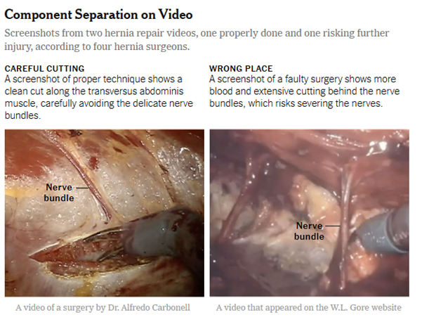 component separation on video