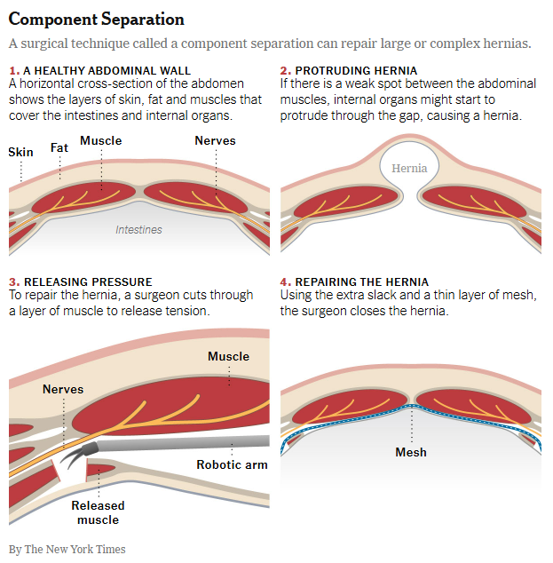 Component Separation